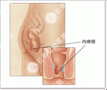 内痔示意图
