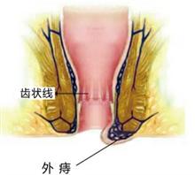 其中外痔疮位于齿状线以下,常分为结缔组织外痔,静脉曲张性外痔,炎性